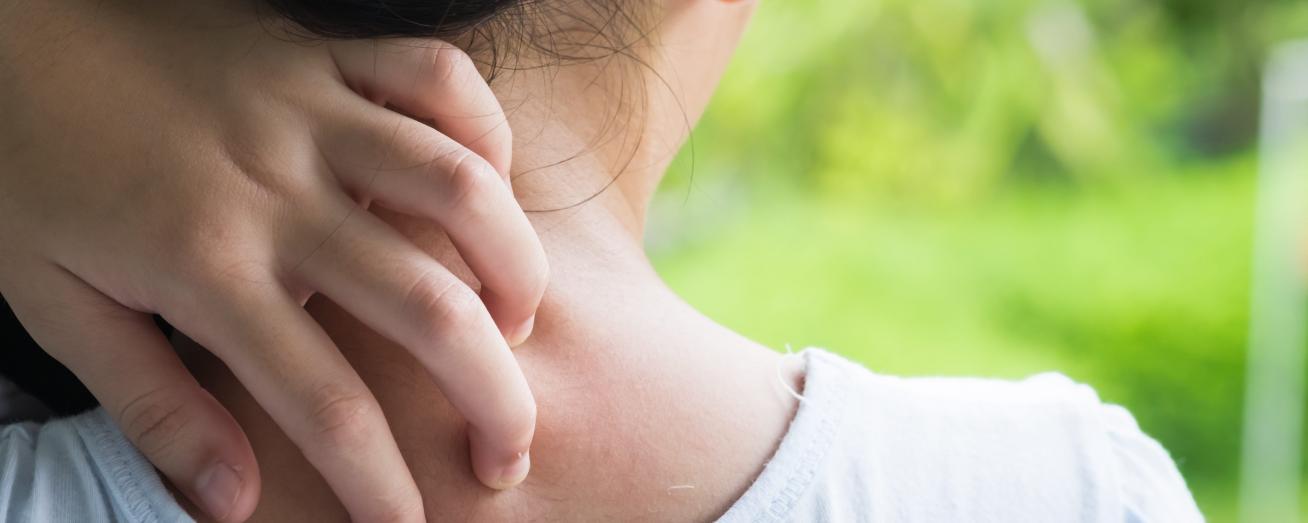 Alergias alimentarias sintomas piel